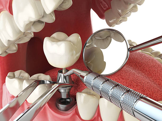 Best Knocked-Out Tooth (Avulsed Tooth) Treatment in Trinity, FL